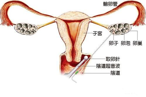 供卵试管卵泡18左右什么时候取