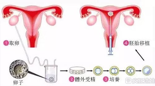 冻胚移植21天后突然腹痛出血怎么回事？