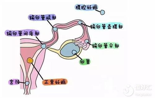 多卵潮能代怀孩子的流程婴儿吗得了多囊卵巢综合症一定要试管吗